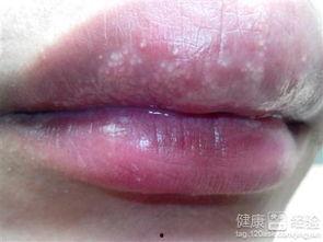 吃蜜瓜后嘴角红肿,揭秘吃蜜瓜后嘴角红肿的奥秘